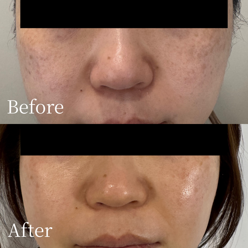 beforeafter_20260116_02 - Re:Birth|大宮エステサロン