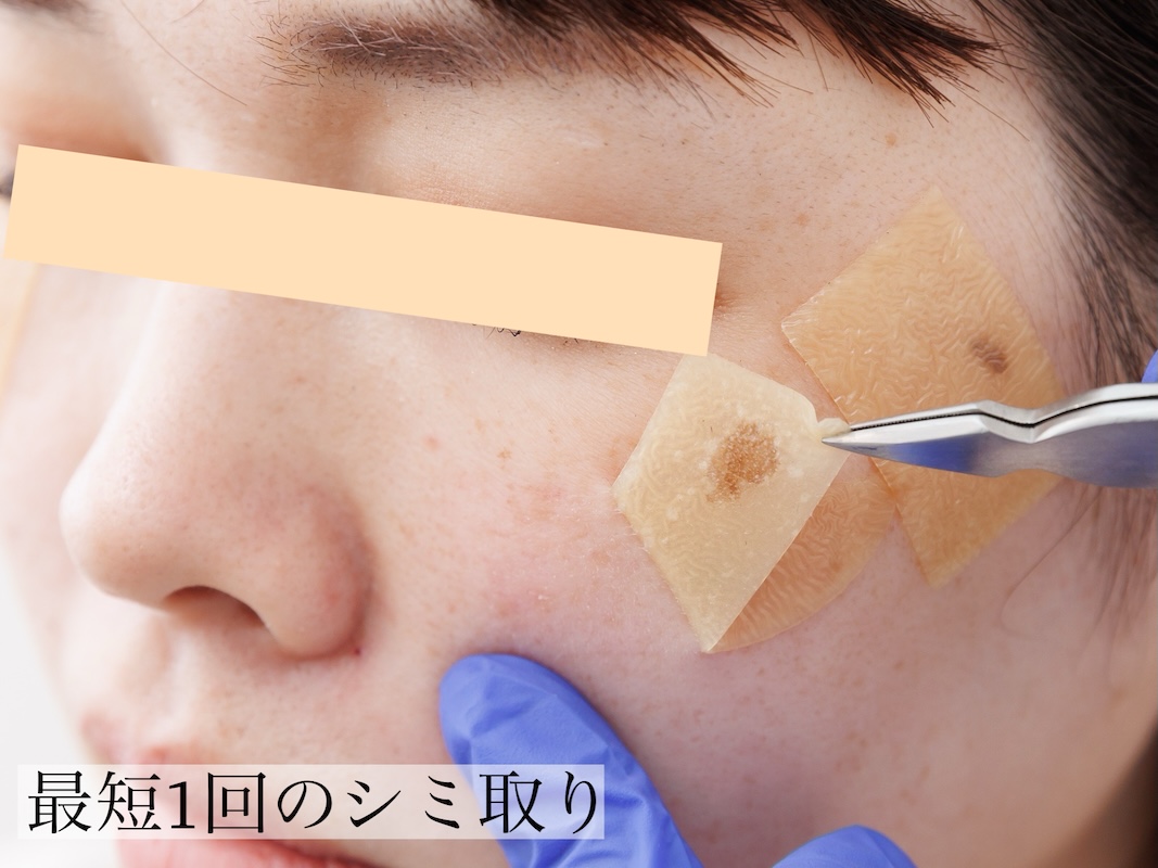 Close-up of a person's cheek during a cosmetic patch removal, with a patch being peeled off using tweezers; blue gloves visible and Japanese caption at bottom reads '最短1回のシミ取り'.